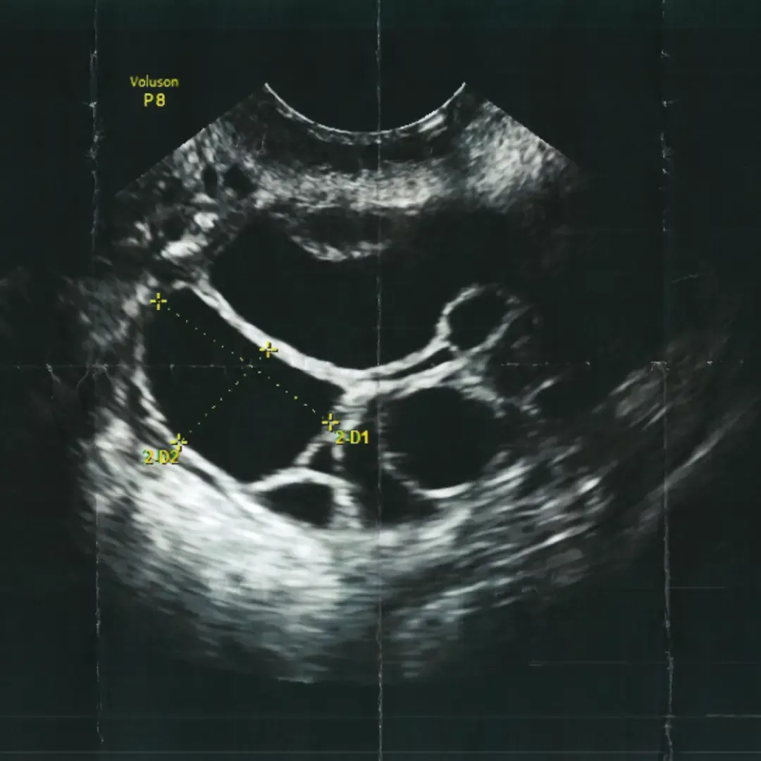 Ultrasound Scan