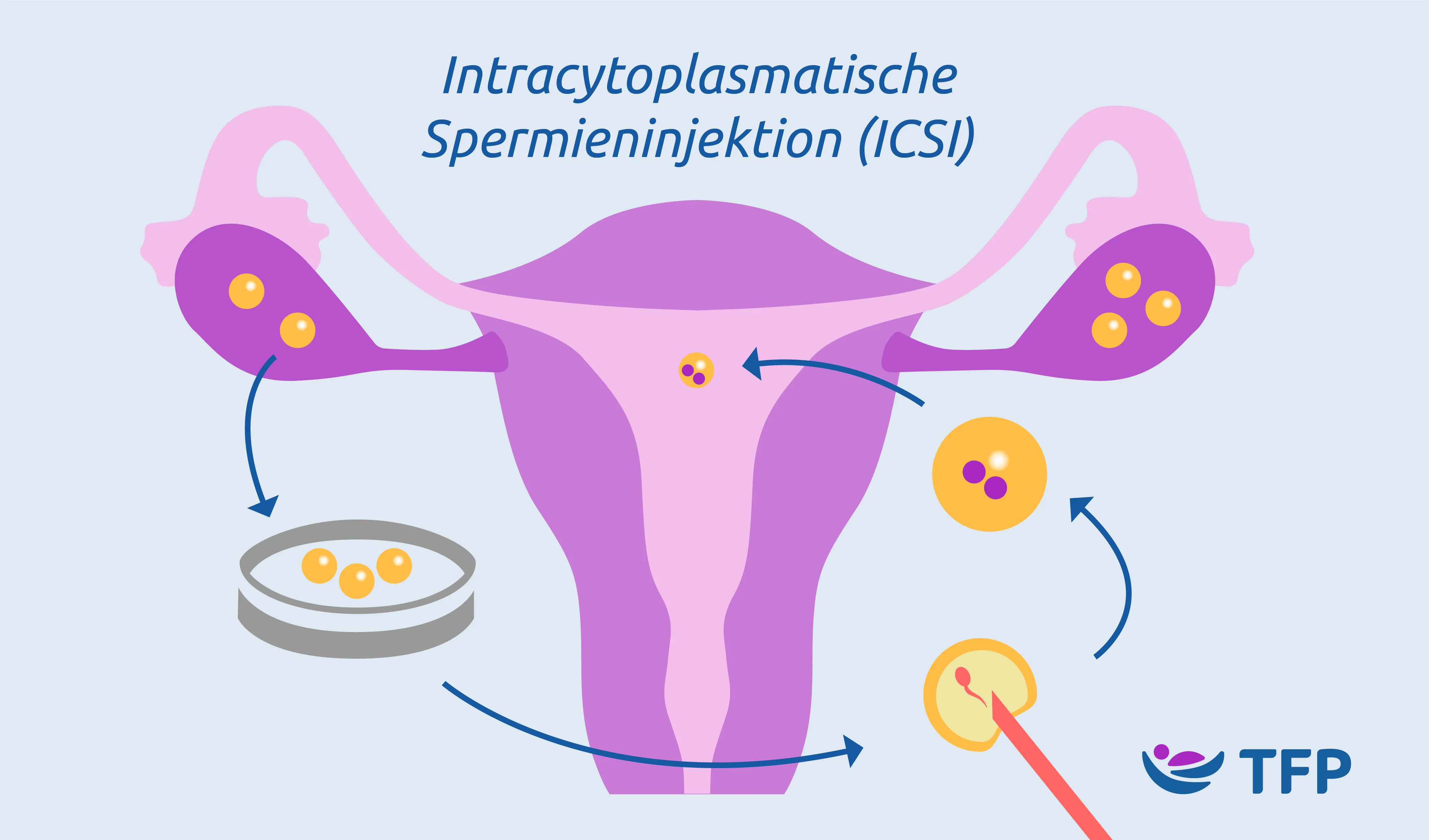 ICSI | TFP