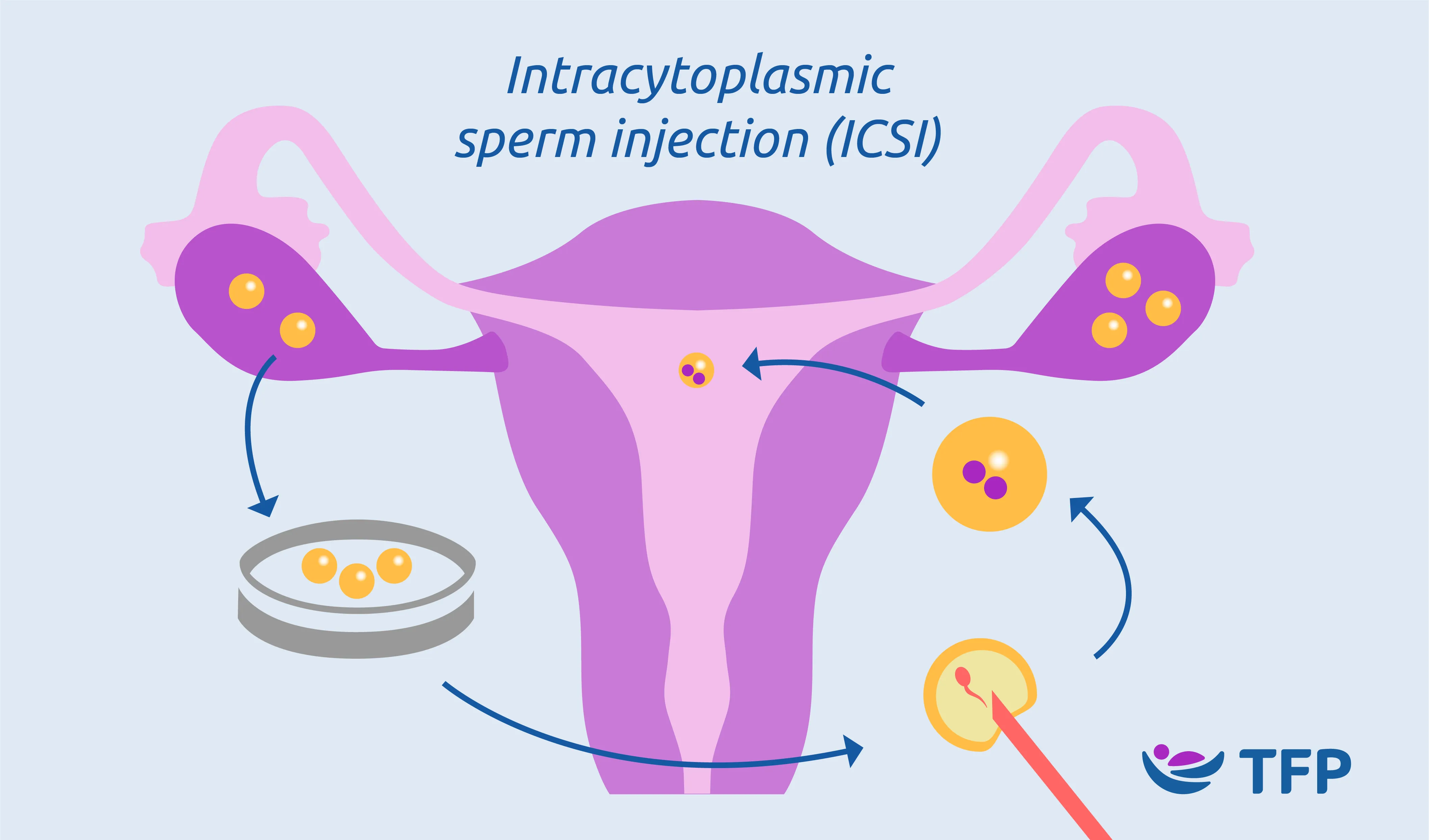 ICSI | TFP